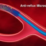 Anti-reflux microcatheter 766×512