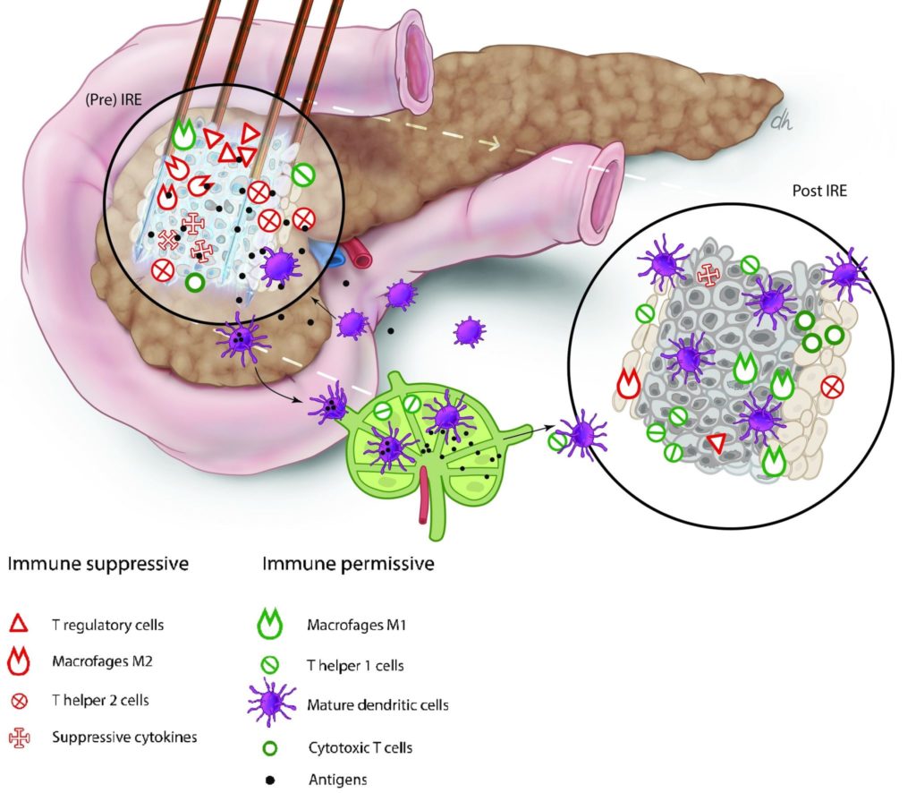 IRE stimulates the immune response to pancreatic cancer