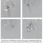 Emborrhoid images