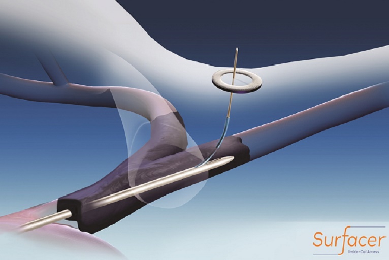 SAVE-US pivotal trial completes enrollment and has positive clinical results