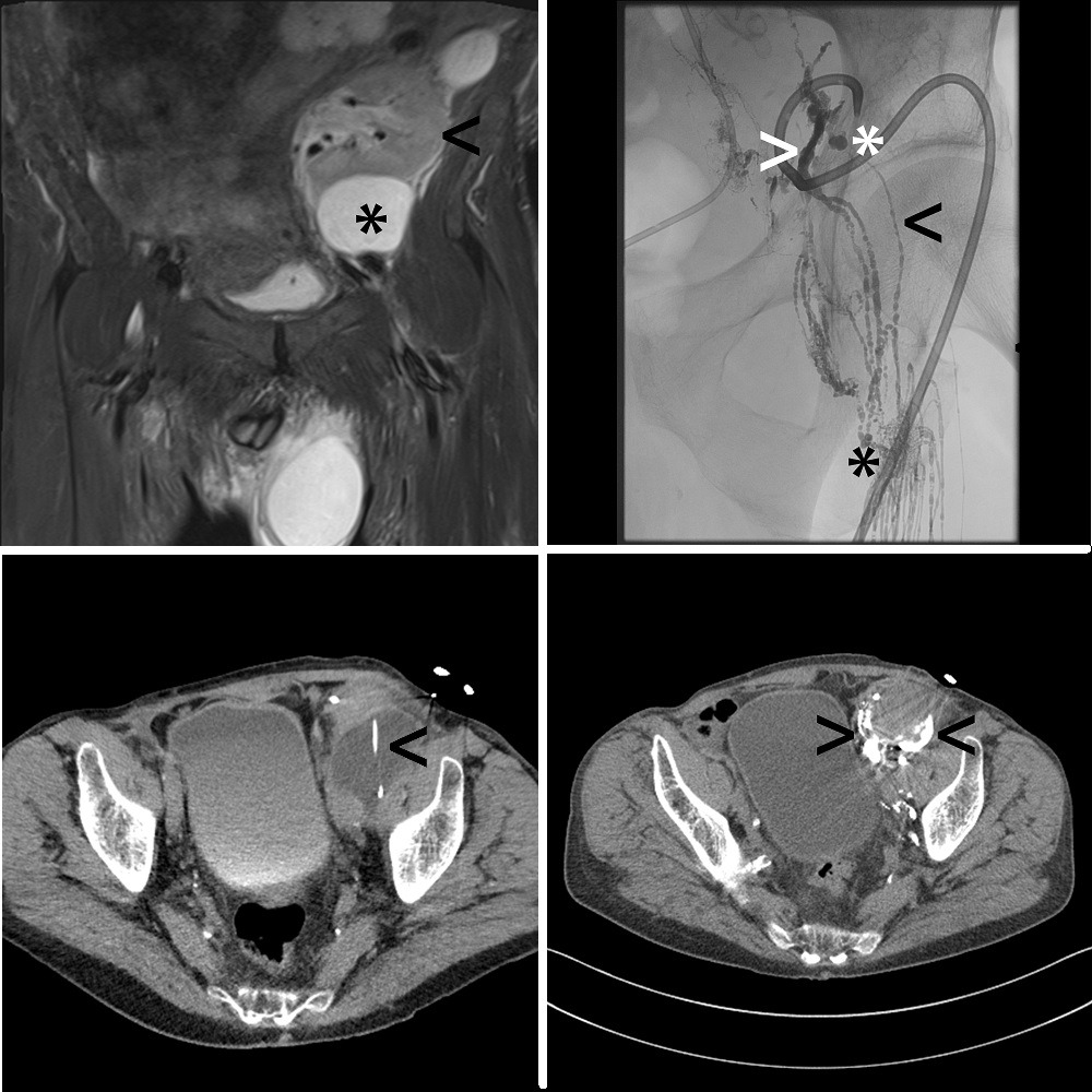 Patient with a space occupying iliac lymphocele (asterisk) after kidney transplantation (arrowhead) (Figure 1, top left); 29 days after positioning of a percutaneous drainage (arrowhead) (Figure 2, bottom left), conventional lymphangiography was performed with 18ml Lipiodol demonstrating the different morphological signs of lymphatic leakage including lymphopseudoaneurysm (white asterisk) and pathologic lymph vessels with Lipiodol extravasation (white arrowhead) as well as afferent lymph nodes (black asterisk) and lymph vessels (black arrowhead) (Figure 3, top right); CT lymphangiography immediately after conventional lymphangiography is regularly performed in our centre to visualize the lymphatic leakage (arrowheads) (and targets for a potential second-line lymphatic intervention) with best spatial resolution and dedicated 3D image resonstruction (Figure 4, bottom right)