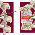vertebroplasty-640×359.jpg