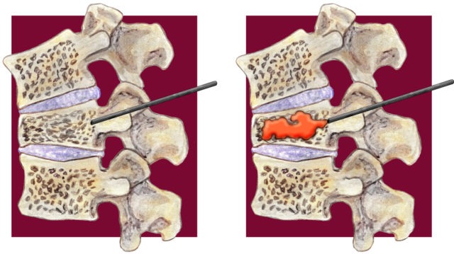 Percutaneous Vertebroplasty for Osteoporotic Compression