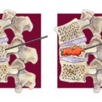 vertebroplasty 766×512