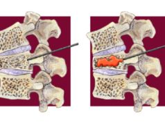 Percutaneous vertebroplasty safe and effective only in patients with acute fractures vertebroplasty