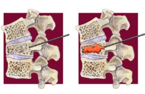 vertebroplasty
