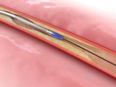 Flex vessel preparation system effectively limits potential complications in the femoral and popliteal arteries Flex