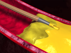 Wingman catheter by Reflow Medical