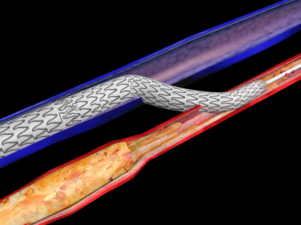 Positive two-year data from ALPS registry of LimFlow system published