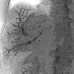 Double vein embolization patient scan