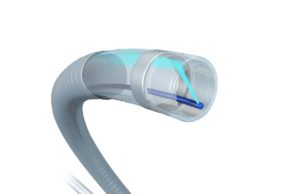 JETi registry reports effective thrombus reduction in lower extremity DVT JETi