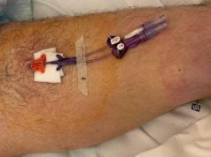 New protocol helps identify best venipuncture site for femoral access femoral