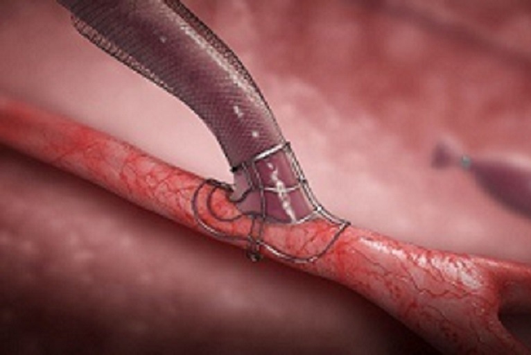 VasQ device improves AVF creation in haemodialysis patients, JVA study reports
