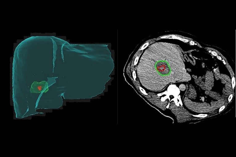 Ablation 2.0: Improved precision as interventionalists approach A0