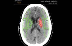 Avicenna.AI receives CE Mark for AI tool to assess stroke severity stroke severity assessment ai