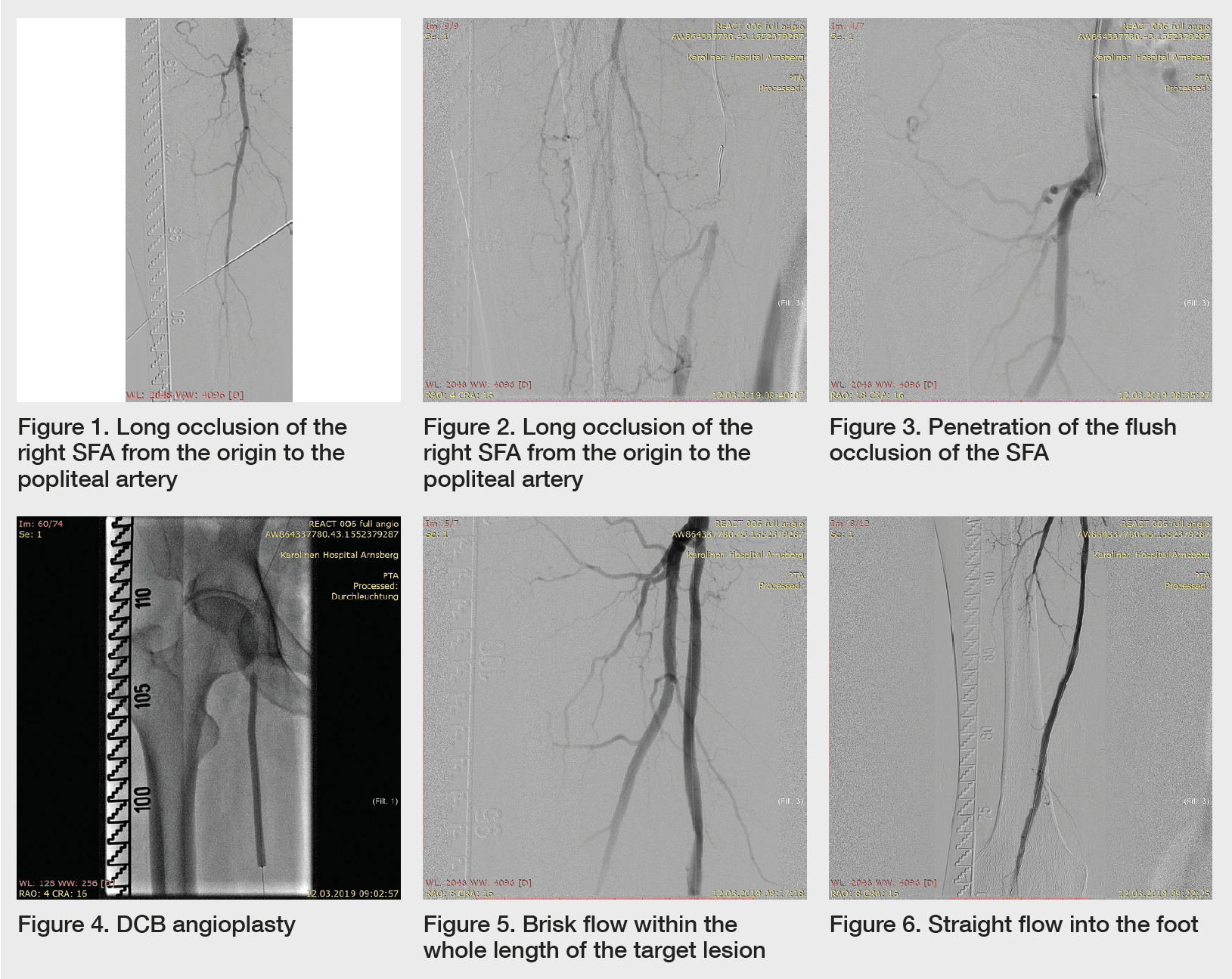 Case report Recanalisation of a long SFA occlusion with Ultrascore