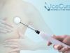 IceCure Medical enrols first patients in US ChoICE cryoablation study IceCure Medical