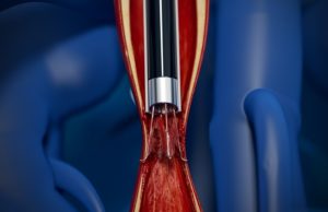 FDA clears CavaClear IVC filter removal laser sheath