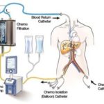 delcatch chemosaturation system