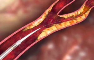 InspireMD announces the inclusion of its CGuard carotid stent in CREST-2 trial