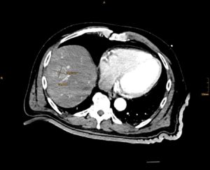 ABLATION PLANNING