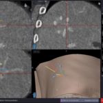 Fig 1c Verification of precise coaxial needle placement by image fusion.