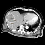 Fig 1d Final contrast-enhanced ct showing large ablation zone with sufficient margin (as confirmed by image fusion)