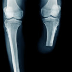 x-ray image below knee amputation or BKA amputation