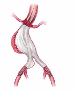 Nellix endovascular aneurysm sealing (EVAS) system