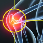 Osteoarthritis knee pain