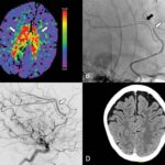 thrombectomy-comparabl