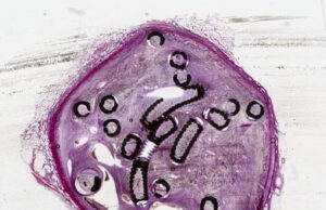 Study finds fibred embolization coils reduce procedure times and radiation exposure