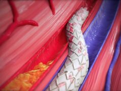 Inari Medical completes LimFlow acquisition for CLTI treatment