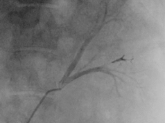 Fluidx Medical launches new embolic platform for tumour treatment Fluidx Medical