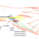 Distal-Radial