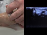 How to manage access via the distal radial route