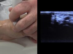 How to manage access via the distal radial route