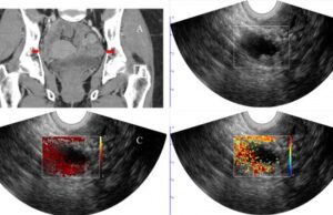 Photoacoustic ultrasound imaging shown to improve diagnostic accuracy of cancerous ovarian lesions