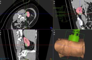 First patient treated with HistoSonics Edison histotripsy system