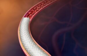 BD announces first patient enrolled in PAD vascular covered stent trial