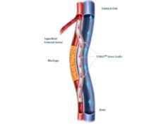 Endologix initiates postmarket study of the Detour system Detour