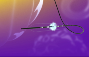 FastWave Medical announces successful 30-day first-in-human data on peripheral IVL technology