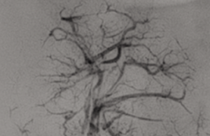 Fluidx Medical announces US FDA approval for embolic device clinical trial Fluidx