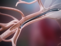 Jupiter Endovascular announce US FDA approval for SPIRARE II trial Jupiter Endovascular