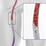 NEW ClotTriever in Anatomy