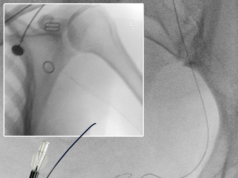 Transit Scientific’s XO Cath microcatheter used in radial access UAE procedure without support catheter XO Cath
