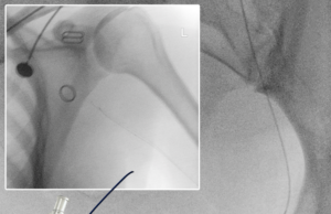 Transit Scientific’s XO Cath microcatheter used in radial access UAE procedure without support catheter XO Cath