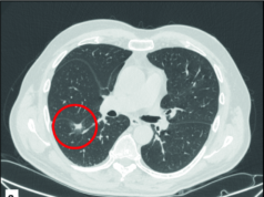 Liquid biopsy shows what you have been missing