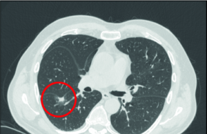 Liquid biopsy shows what you have been missing
