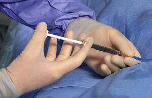 Fluidx Medical announces first patient treated in prospective trial Fluidx Medical